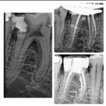 Same Day Root Canal Treatment