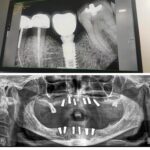 Same Day Implant With Crown