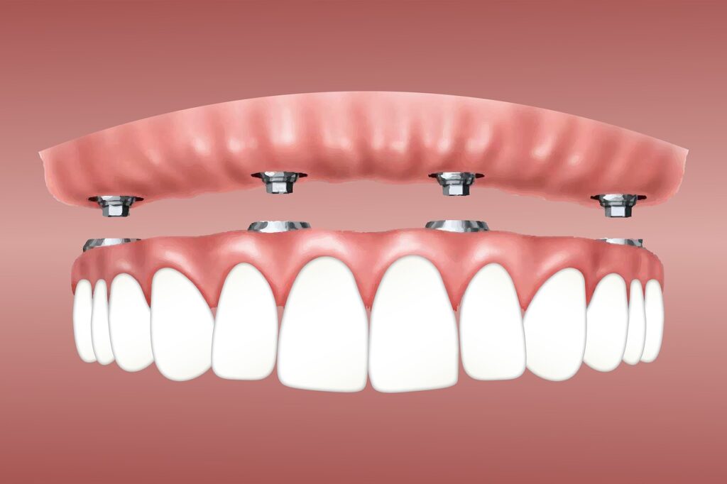 overdenture, implant, retained-3597628.jpg